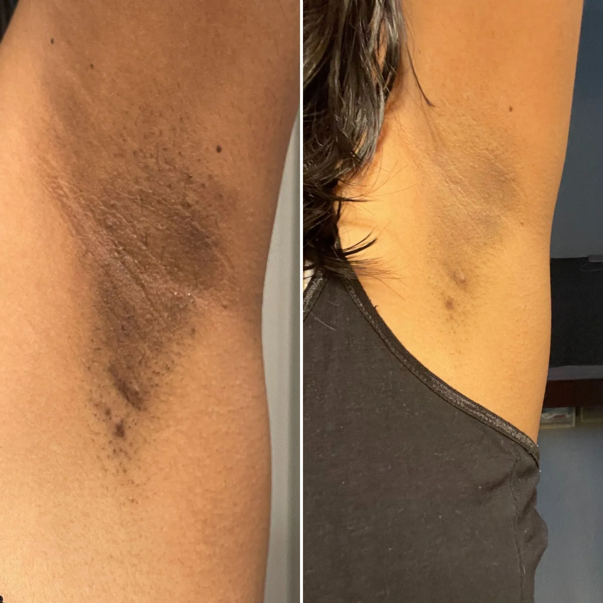 Before_and_After_Dark_Underarm_Treatment_2048x2048